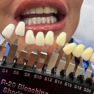 Сuánto dura el blanqueamiento dental