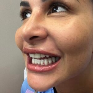 Blanqueamiento dental profesional en Valencia – cómo funciona el procedimiento y qué resultados esperar